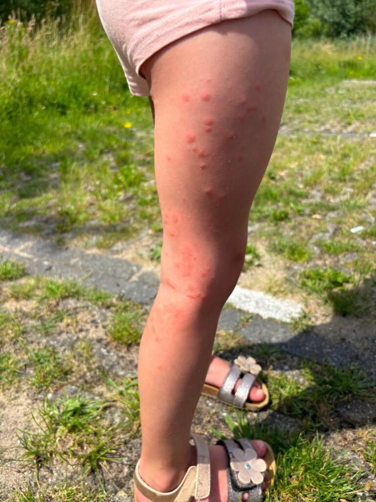 Zwemplezier slaat om in zorgen: jeuk en huiduitslag na bezoek aan Noord Aa